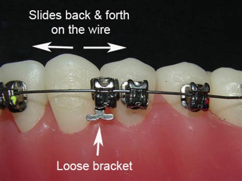 metal bracket came off tooth|dental bracket pops off.